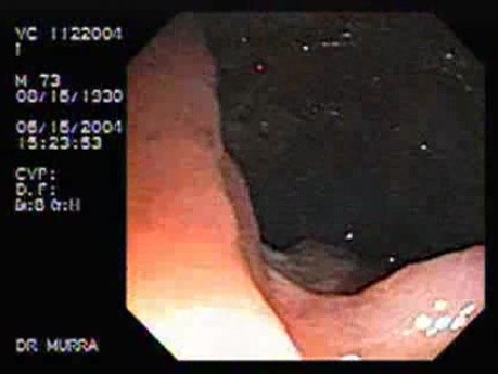 Crohn´s Disease Of The Ileocecal Valve And Terminal Ileum (2 of 5)