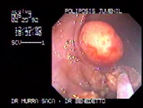 Non Familial Juvenile Polyposis Of The Colon (12 of 37)