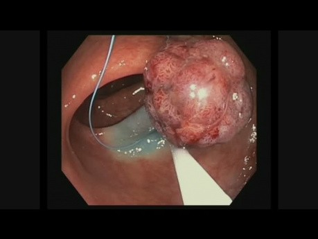 Endoloop Polypectomy