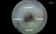 Endoscopic Interlaminar Approach L5-S1