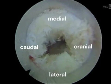 Endoscopic Interlaminar Approach L5-S1
