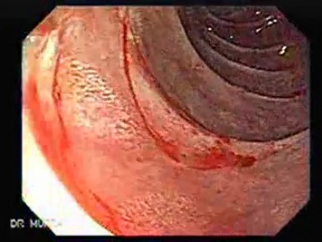 Adenocarcinoma of the Cardias - Closer Look at the Papilla of Vater, Part 2