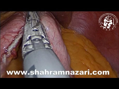 Reinforcement Using Sutures on Sleeve Gastrectomy Staple Line
