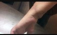 Replantation Case 5