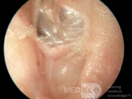 Prior Idiopathic Osteitis of the Floor of the External Canal Re-epithilialized following Sequestrtion and Extrusion the de-vitalized Bone