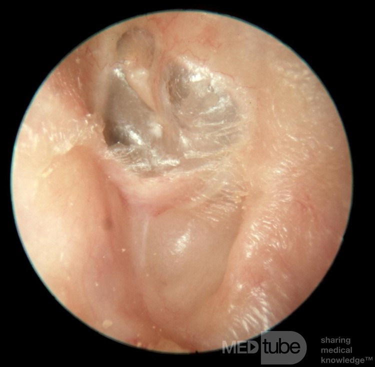 Prior Idiopathic Osteitis of the Floor of the External Canal Re-epithilialized following Sequestrtion and Extrusion the de-vitalized Bone