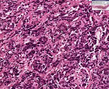 Adrenal Insufficiency - Primary Chronic Adrenal Insufficiency