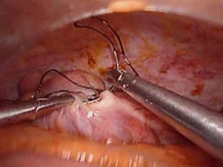 Colonic Perforation With Peritonitis - Laparoscopy (18 of 46)