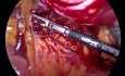 Laparoscopic Rectosigmoid Resection