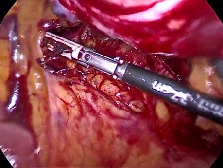 Laparoscopic Rectosigmoid Resection