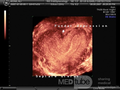 Bicornuate Uterus by 3D Ultrasound