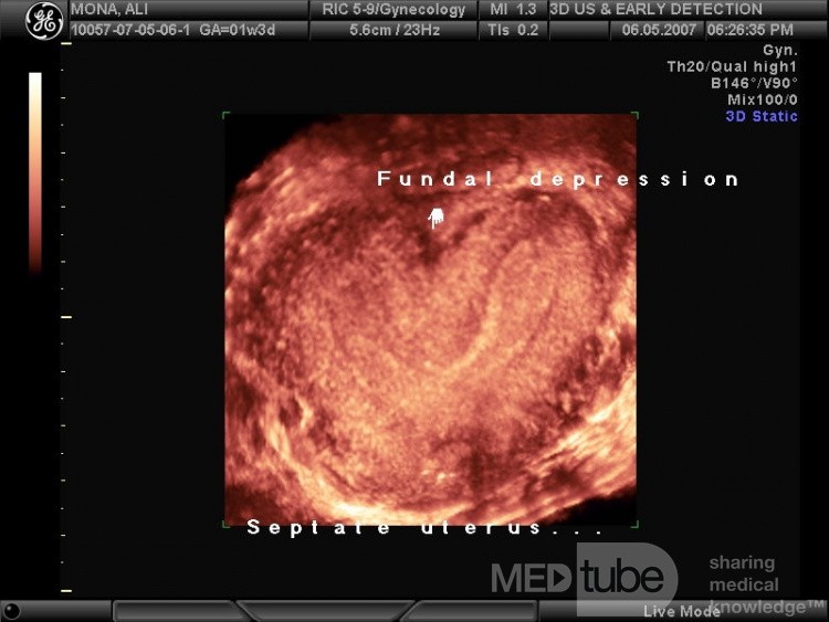 Bicornuate Uterus by 3D Ultrasound