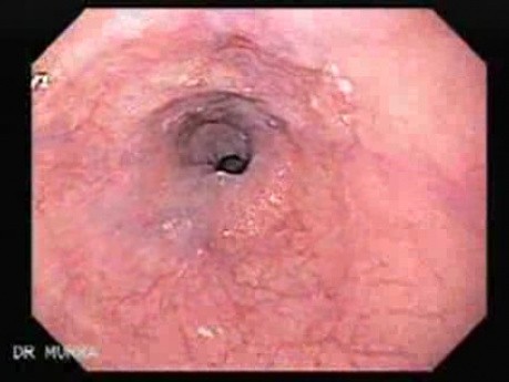 Esophageal Varices and Hiatus Hernia - Presentation of Esophageal Mucosa