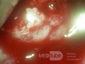 Cervical adenocarcinoma (carcinoma glandulare colli uteri)