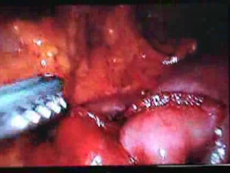 Jejunal Gastrointestinal Stromal tumor (GIST) (82 of 86)