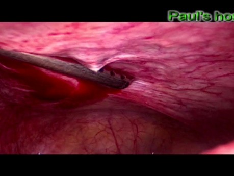 Tracheloplasty