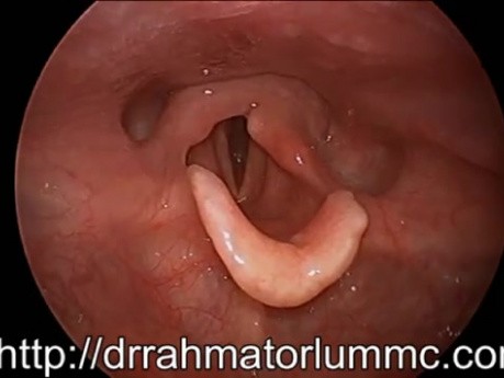 The Vocal Fold Palsy Fully Compensated in HD