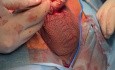 Suture in the Implant Penile Prosthesis tubing