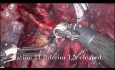 Robotic Lobectomy for Carcinoid Tumour Occluding the Basal Right Lower Lobe Bronchus