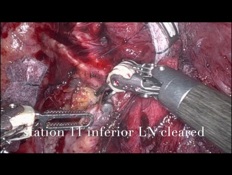 Robotic Lobectomy for Carcinoid Tumour Occluding the Basal Right Lower Lobe Bronchus