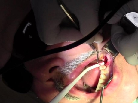 Extraction #18 With Simple Socket Bone Grafting