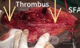 Long Segment Femoral Artery Thrombus - Traumatic