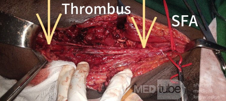Long Segment Femoral Artery Thrombus - Traumatic