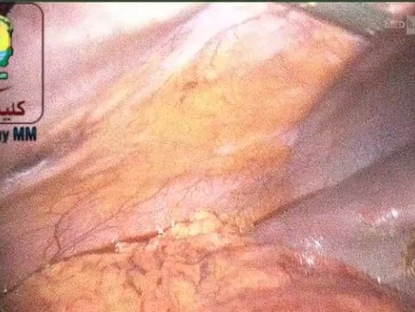 Nasr Fascial Closure Device Can Secure the Port Site
