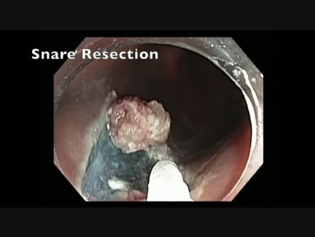 Rectum - LST Granular Tumor - EMR