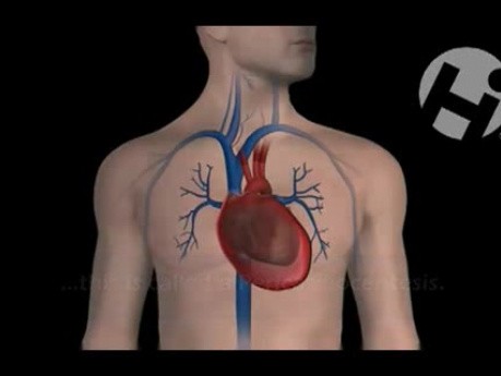 Pericardiocentesis