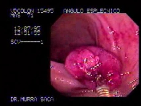 Large Ulcerated Polyp