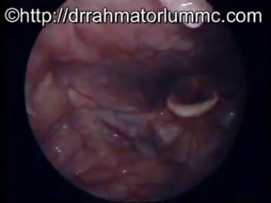 Fishbone Partially Embedded in Right Tonsillar Tissue Removal