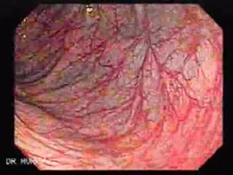 Colitis Ulcerosa - Pseudopolyps (10 of 22)