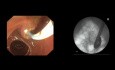ERCP in Altered Anatomy