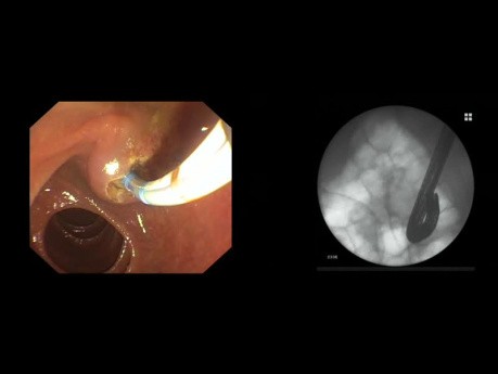 ERCP in Altered Anatomy