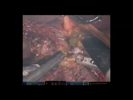 Robotic Pancreaticoduodenectomy for Ductal Adenocarcinoma