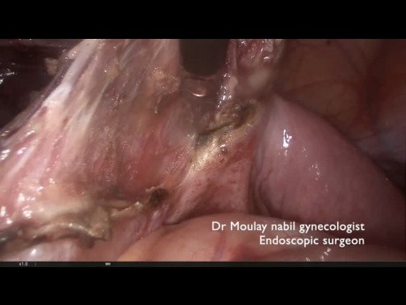 Hemihysterectomy, bicornuate uterus, obstructed rudimentary horn