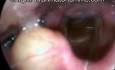 Epiglottic Cyst - Right Side