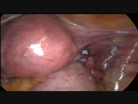 Laproscopy Recanalisation