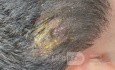 Kerion (Tinea Capitis Infection)
