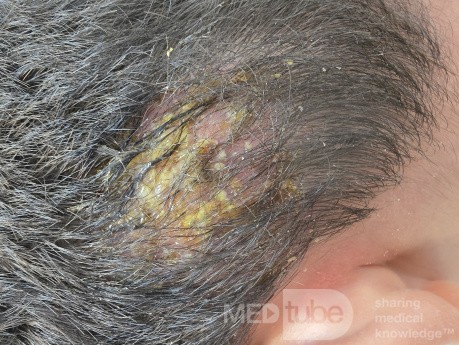Kerion (Tinea Capitis Infection)