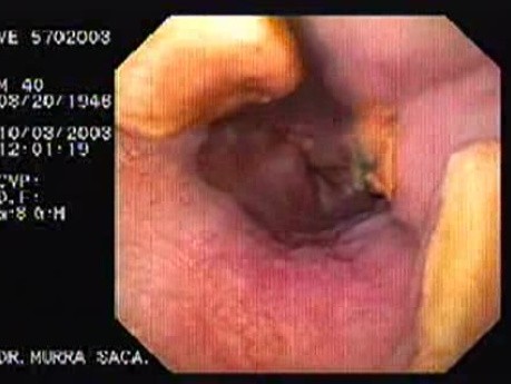 Acute Variceal Bleeding - Necrotic Varices After Ligation, Part 1