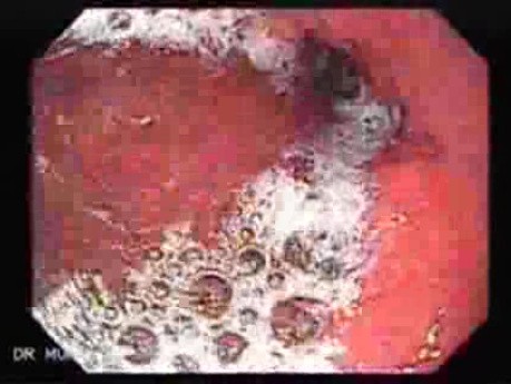 Scirrhous Gastric Carcinoma - Endoscopy (13 of 47)