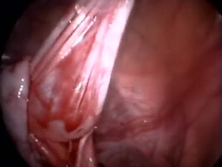 Laparoscopic Cystectomy 