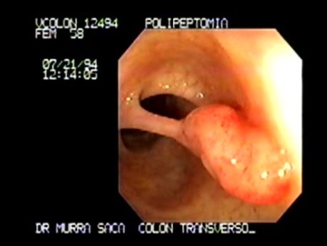 Large Pediculated Polyp - Snare Polypectomy (1 z 5)