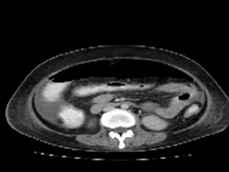 Multiple Rectal Ulcers (47 of 110)