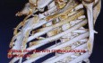 Chest Wall Reconstruction for Flail Chest