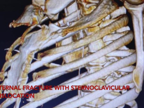 Chest Wall Reconstruction for Flail Chest