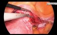 Total Laparoscopic Hysterectomy With Indocyanine Green
