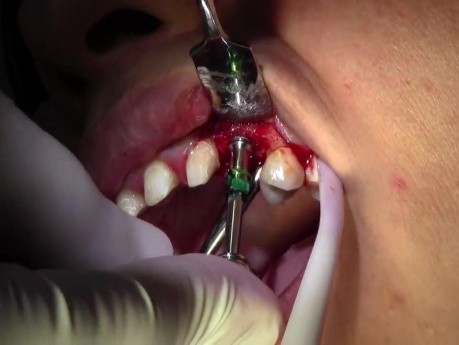 Implant Insertion - Implant Surgery, #11 Site